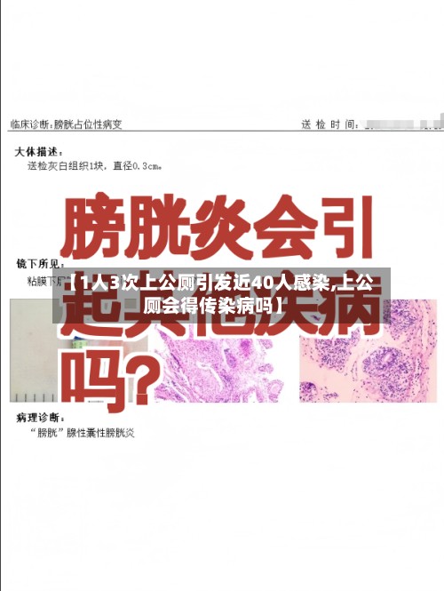 【1人3次上公厕引发近40人感染,上公厕会得传染病吗】-第2张图片